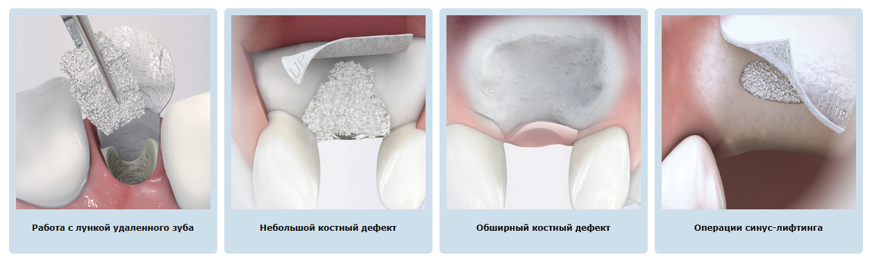 Применение БиоОсс