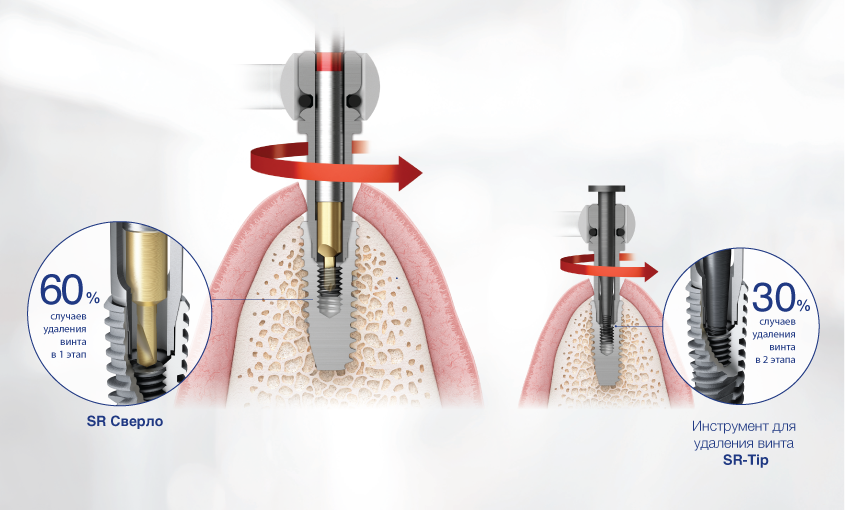 Набор для извлечения винта ESR Kit