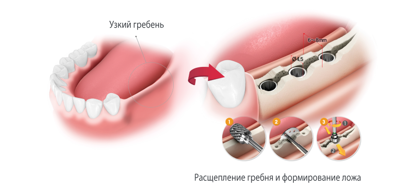 Набор для расщепления Esset Osstem