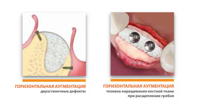 ламина остеобиол
