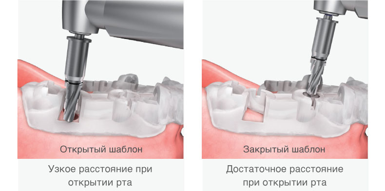 Набор навигационный One Guide Osstem