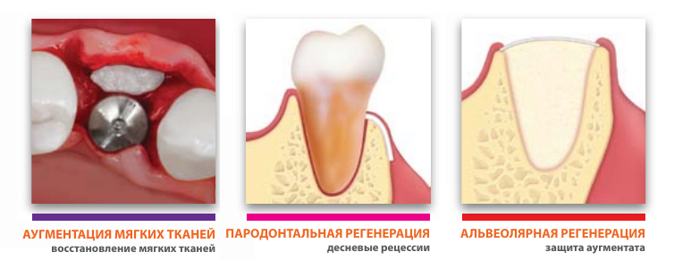 клинические показания для мембраны дерма